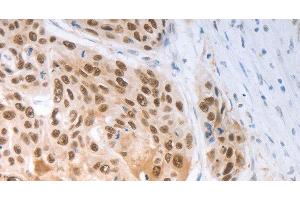 Immunohistochemistry of paraffin-embedded Human ovarian cancer tissue using SLC22A8 Polyclonal Antibody at dilution 1:70 (SLC22A8 Antikörper)