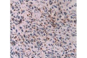 IHC-P analysis of stomach cancer tissue, with DAB staining. (OAS1 Antikörper  (AA 74-165))
