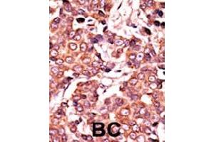 Formalin-fixed and paraffin-embedded human cancer tissue reacted with CDC25A (phospho S278) polyclonal antibody  which was peroxidase-conjugated to the secondary antibody followed by AEC staining.