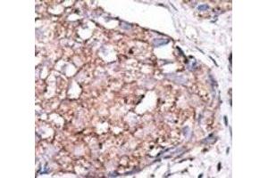 IHC analysis of FFPE human hepatocarcinoma stained with the SIGLEC7 antibody (SIGLEC7 Antikörper  (AA 407-438))
