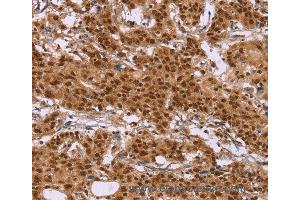 Immunohistochemistry of Human liver cancer using CTNNBL1 Polyclonal Antibody at dilution of 1:50 (CTNNBL1 Antikörper)