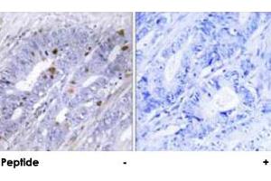Immunohistochemical analysis of paraffin-embedded human colon carcinoma tissue using NR4A1 polyclonal antibody . (NR4A1 Antikörper)