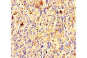 Immunohistochemistry of paraffin-embedded human melanoma using ABIN7162191 at dilution of 1:100 (OR5L1 Antikörper  (AA 161-196))