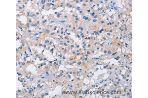 Immunohistochemistry of Human thyroid cancer using ATP6AP2 Polyclonal Antibody at dilution of 1:50