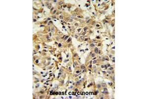 CA6 Antibody (C-term) IHC analysis in formalin fixed and paraffin embedded breast carcinoma followed by peroxidase conjugation of the secondary antibody and DAB staining.