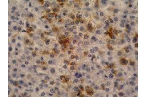 Immunohistochemistry of paraffin-embedded sections (hepatocellular carcinoma) Immunohistochemistry staining of hepatocellular carcinoma (fetal liver; paraffin-embedded sections) with anti-human alpha-Fetoprotein (AFP-11).