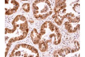 IHC-P Image Immunohistochemical analysis of paraffin-embedded human lung cancer, using CIS, antibody at 1:100 dilution. (CISH Antikörper  (C-Term))