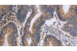 Immunohistochemistry of paraffin-embedded Human colon cancer tissue using ITPR1 Polyclonal Antibody at dilution 1:40 (ITPR1 Antikörper)