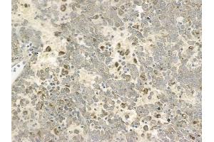 ABIN6257409 and ABIN6273693 at 1/100 staining human melanoma by IHC-P. (PAK1IP1 Antikörper  (C-Term))