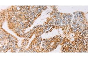 Immunohistochemistry of paraffin-embedded Human colon cancer tissue using YARS2 Polyclonal Antibody at dilution 1:30 (YARS2 Antikörper)