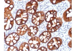 Formalin-fixed, paraffin-embedded human Colon Carcinoma stained with EpCAM Mouse Recombinant Monoclonal Antibody (rMOC-31). (Rekombinanter EpCAM Antikörper)