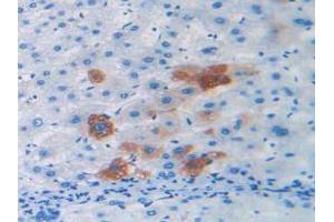 IHC-P analysis of Human Liver Cancer Tissue, with DAB staining. (Relaxin 2 Antikörper  (AA 1-186))