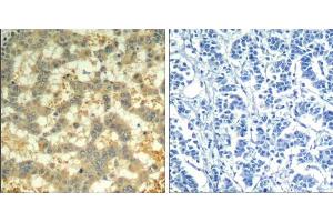 Immunohistochemical analysis of paraffin-embedded human breast carcinoma tissue using syk (phospho-Tyr323) Antibody (E011546). (SYK Antikörper  (pTyr323))