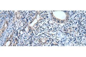 Immunohistochemistry of paraffin-embedded Human cervical cancer tissue using USP32 Polyclonal Antibody at dilution of 1:75(x200) (USP32 Antikörper)