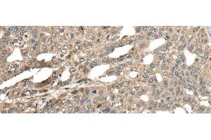 Immunohistochemistry of paraffin-embedded Human liver cancer tissue using MCPH1 Polyclonal Antibody at dilution of 1:110(x200)