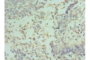 Immunohistochemistry of paraffin-embedded human cervical cancer using ABIN7153389 at dilution of 1:100 (Cyclin D2 Antikörper  (AA 1-289))