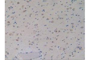 IHC-P analysis of Human Glioma Tissue, with DAB staining. (GDF2 Antikörper  (AA 32-427))