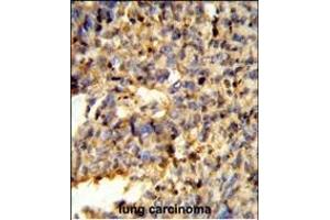 Formalin-fixed and paraffin-embedded human lung carcinoma reacted with FCGR2C Antibody (C-term), which was peroxidase-conjugated to the secondary antibody, followed by DAB staining.
