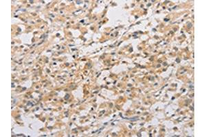 The image on the left is immunohistochemistry of paraffin-embedded Human thyroid cancer tissue using ABIN7128532(ARSF Antibody) at dilution 1/20, on the right is treated with fusion protein. (ARSF Antikörper)