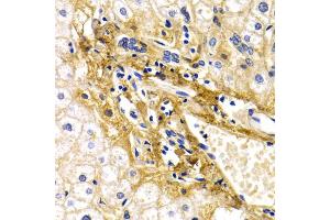Immunohistochemistry of paraffin-embedded human liver injury using CFH antibody (ABIN5971193) at dilution of 1/200 (40x lens). (Complement Factor H Antikörper)