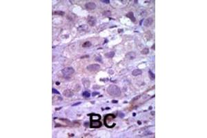 Formalin-fixed and paraffin-embedded human cancer tissue reacted with the primary antibody, which was peroxidase-conjugated to the secondary antibody, followed by AEC staining. (Ret Proto-Oncogene Antikörper  (N-Term))