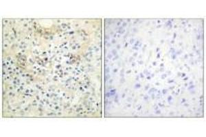 Immunohistochemistry analysis of paraffin-embedded human prostate carcinoma tissue, using TM16G antibody. (Anoctamin 7 Antikörper  (C-Term))