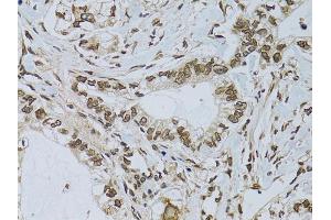 Immunohistochemistry of paraffin-embedded human gastric cancer using EMD antibody. (Emerin Antikörper)