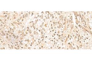 Immunohistochemistry of paraffin-embedded Human liver cancer tissue using MDFI Polyclonal Antibody at dilution of 1:55(x200) (MDFI Antikörper)