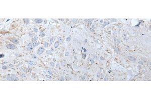 Immunohistochemistry of paraffin-embedded Human esophagus cancer tissue using RASA1 Polyclonal Antibody at dilution of 1:40(x200)