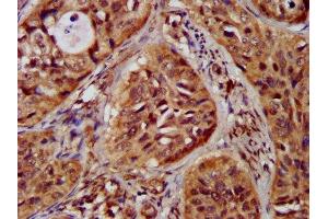 IHC image of ABIN7147960 diluted at 1:300 and staining in paraffin-embedded human cervical cancer performed on a Leica BondTM system. (ST3GAL4 Antikörper  (AA 39-184))