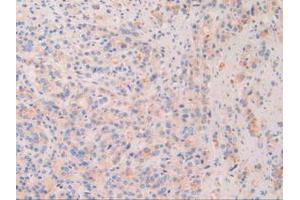 IHC-P analysis of Human Prostate Gland Cancer Tissue, with DAB staining. (Chordin Antikörper  (AA 700-918))