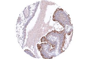 Gastric adenocarcinoma of the fundic gland type with distinct pepsinogen I staining of tumor cells