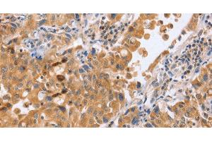 Immunohistochemistry of paraffin-embedded Human lung cancer tissue using BLNK Polyclonal Antibody at dilution 1:50 (B-Cell Linker Antikörper)