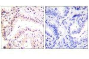 Immunohistochemical analysis of paraffin-embedded human lung carcinoma tissue using Cullin 2 antibody. (Cullin 2 Antikörper)