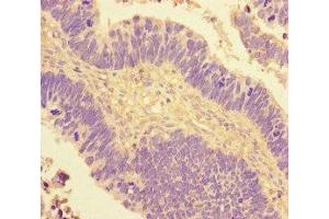 Immunohistochemistry of paraffin-embedded human ovarian cancer using ABIN7148641 at dilution of 1:100 (NR2F2 Antikörper  (AA 123-383))