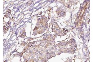 ABIN6273030 at 1/100 staining Human breast cancer tissue by IHC-P. (AFG3L2 Antikörper  (C-Term))