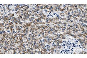 ABIN6275386 at 1/100 staining Human liver cancer tissue by IHC-P.