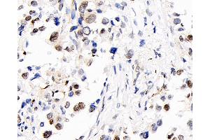 Immunohistochemistry analysis of paraffin-embedded human lung cancer using S100A4 Polyclonal Antibody at dilution of 1:400. (s100a4 Antikörper)