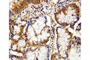IHC-P: Caspase-10 antibody testing of human intestinal cancer  tissue