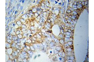 Immunohistochemistry of paraffin-embedded Prostate cancer using HSPA5 antibody. (GRP78 Antikörper  (AA 550-650))