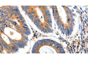 Immunohistochemistry of paraffin-embedded Human colon cancer tissue using IGFBP7 Polyclonal Antibody at dilution 1:50 (IGFBP7 Antikörper)