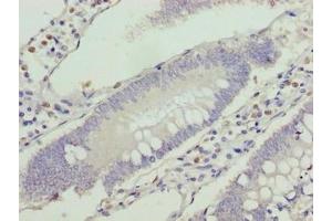 Immunohistochemistry of paraffin-embedded human colon cancer using ABIN7175336 at dilution of 1:100 (VPS25 Antikörper  (AA 1-176))