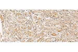 Immunohistochemistry of paraffin-embedded Human liver cancer tissue using GPR22 Polyclonal Antibody at dilution of 1:50(x200) (GPR22 Antikörper)