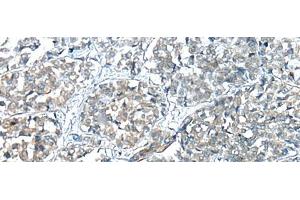 Immunohistochemistry of paraffin-embedded Human esophagus cancer tissue using COMMD6 Polyclonal Antibody at dilution of 1:45(x200) (COMMD6 Antikörper)
