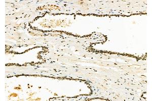 ABIN6262249 and ABIN6273123 at 1/100 staining Human liver cancer by IHC-P. (HIST1H1C Antikörper  (N-Term))