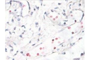 Immunostaining of human breast cancer tissue showing p38 when phosphorylated at Thr180/Tyr182 in red. (MAPK14 Antikörper  (pThr180, pTyr182))