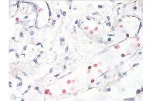 Immunostaining of human breast cancer tissue showing p38 when phosphorylated at Thr180/Tyr182 in red. (MAPK14 Antikörper  (pThr180, pTyr182))