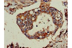 Immunohistochemistry of paraffin-embedded human pancreatic cancer using ABIN7173913 at dilution of 1:100 (TPD52L2 Antikörper  (AA 1-206))