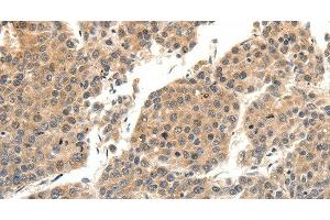 Immunohistochemistry of paraffin-embedded Human liver cancer tissue using SLC27A1 Polyclonal Antibody at dilution 1:40 (SLC27A1 Antikörper)