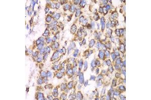 Immunohistochemistry of paraffin-embedded human esophageal cancer using ATP5A1 antibody at dilution of 1:100 (x40 lens). (ATP5A1 Antikörper)